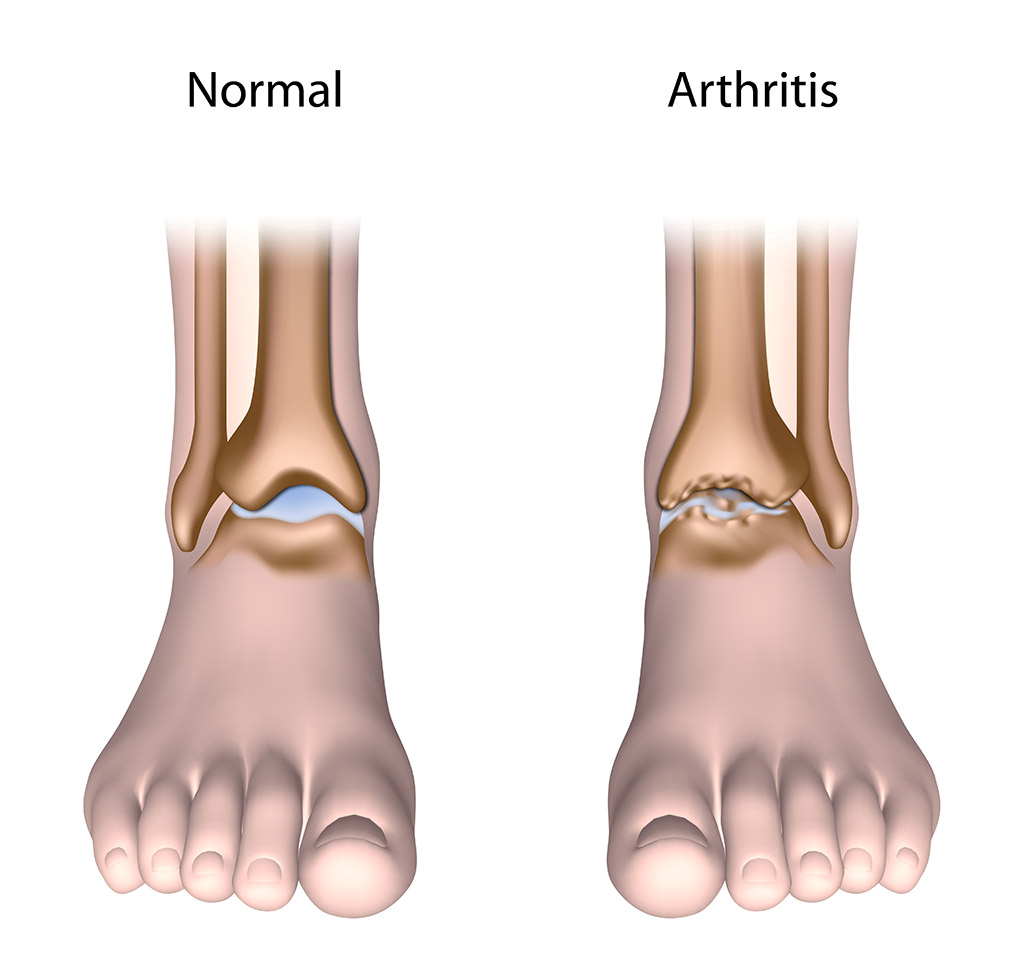 arthrose des pieds